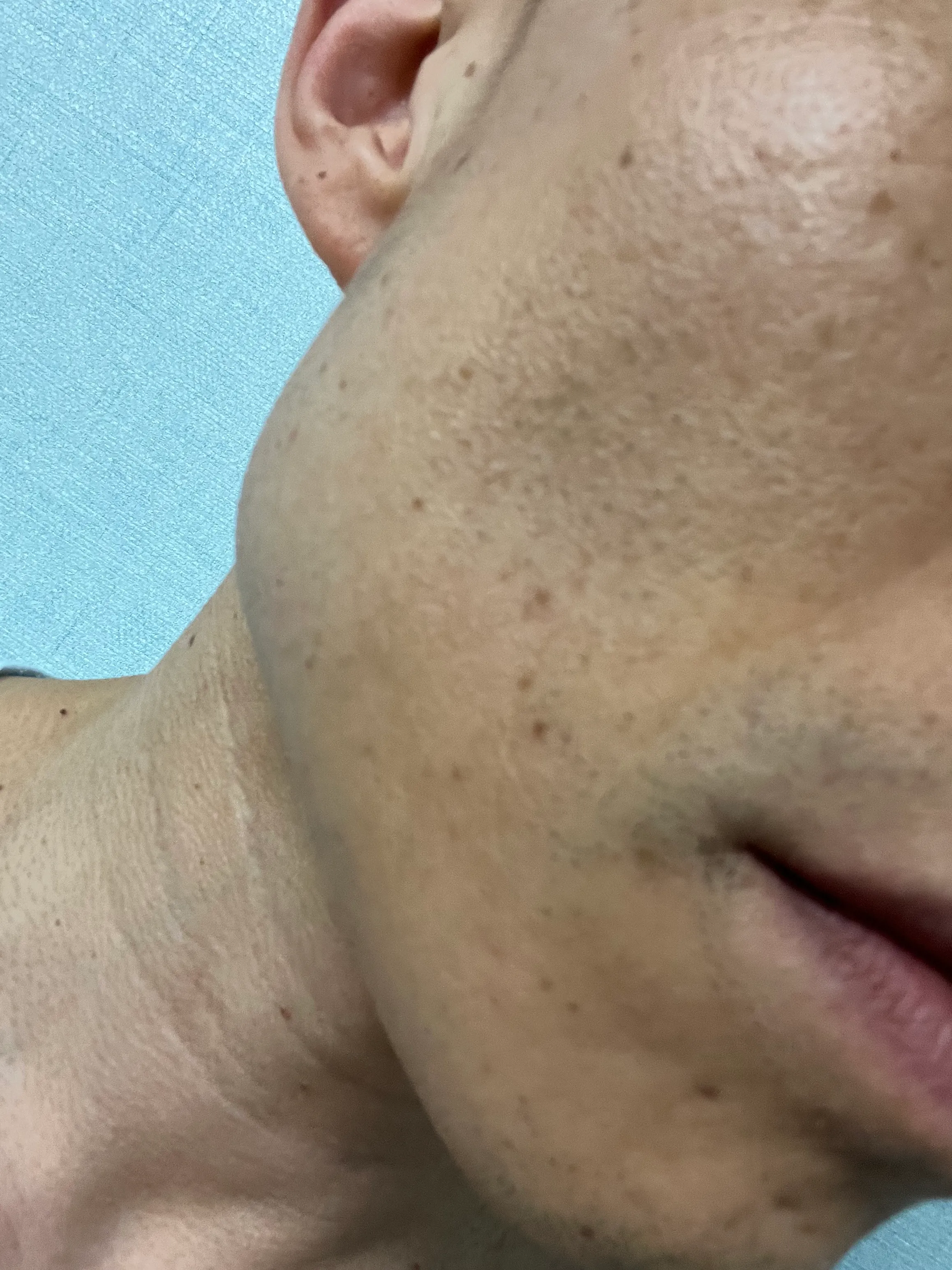 시술 전 — 구로) 인기 보톡스 시술 모음