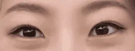시술 전 — 눈성형~ 또렷하게 예쁜눈 