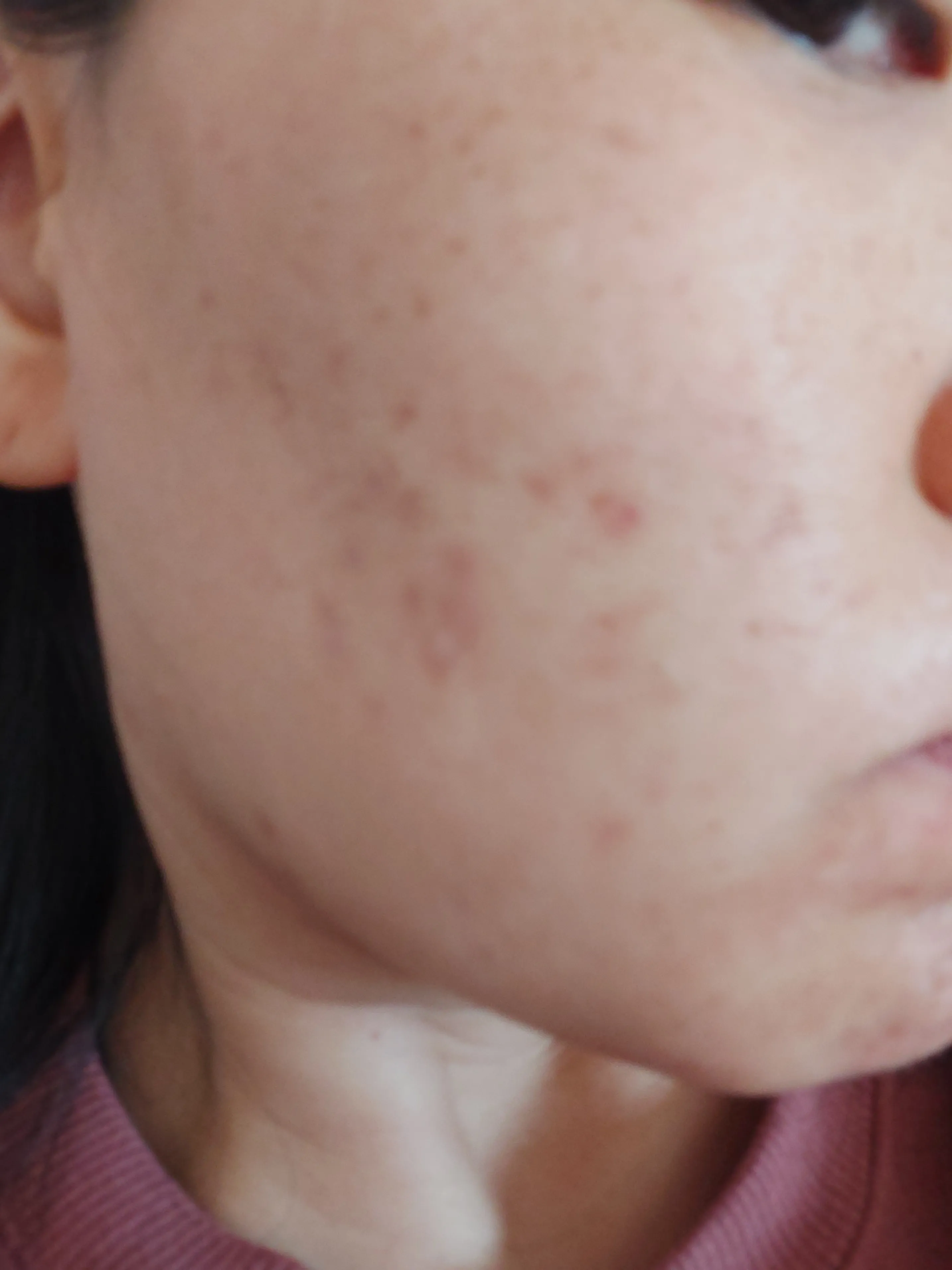 시술 전 — [잡티지우개]에이톤레이저