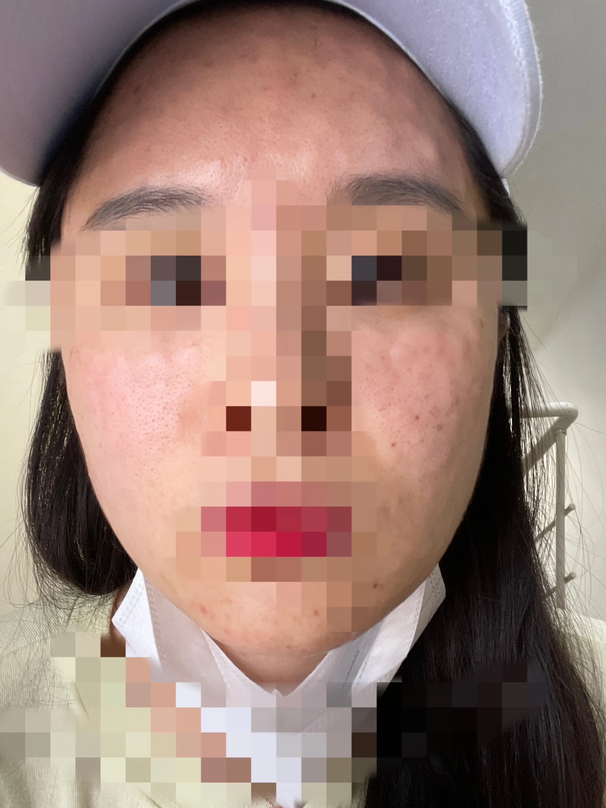 After treatment — Sleep Rejuran 29.9