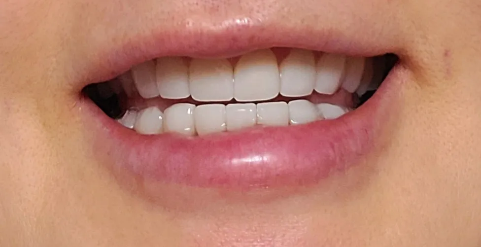 After treatment — 30-Minute Complete Teeth Whitening Program
