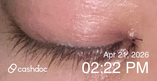 강남구 그랜드성형외과의원, 트임 시술 후 만족해요!