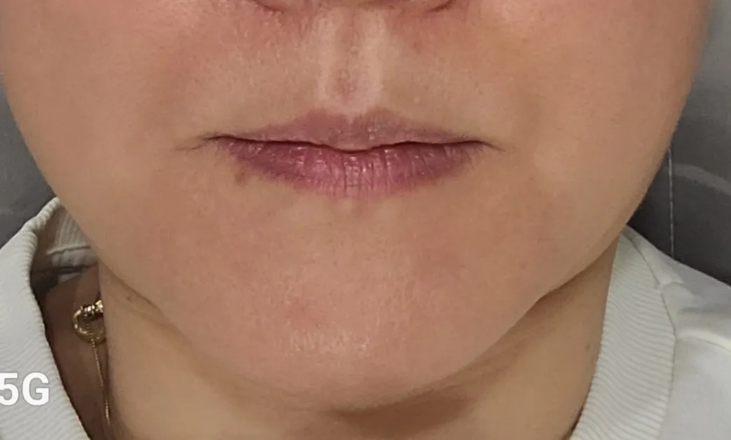 After treatment — Suwon) Wrinkle & Jawline Botox
