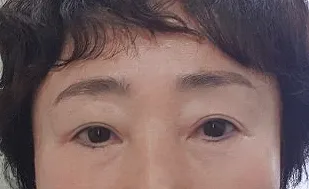 시술 후 — 눈매교정 