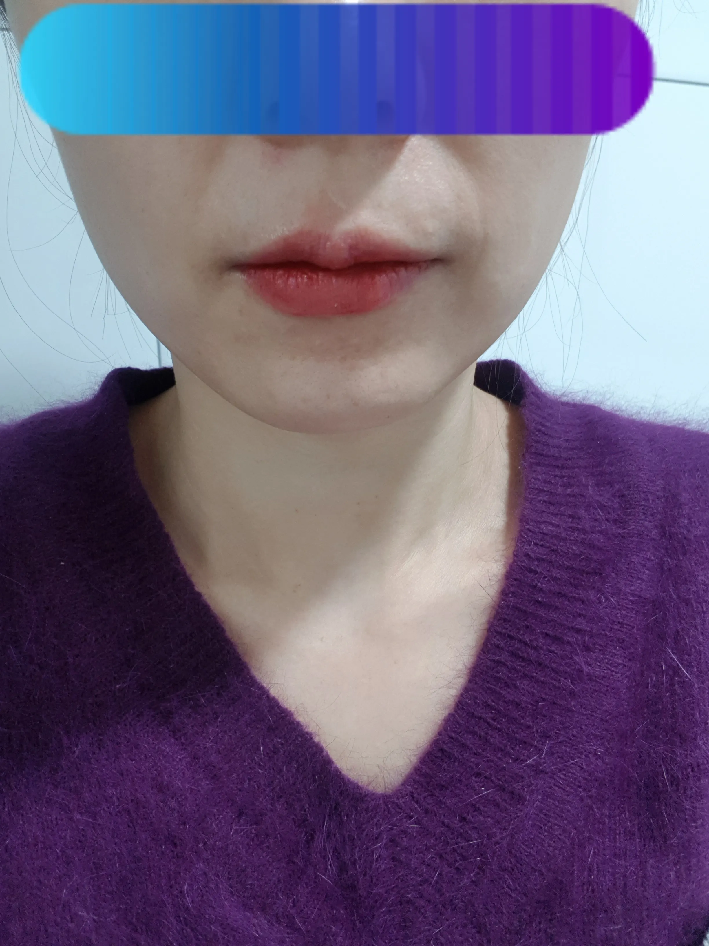 시술 후 — 생기있는 톤업 입술반영구