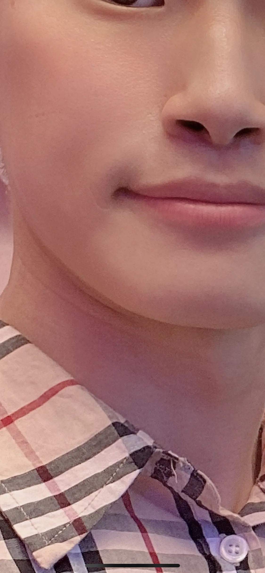 시술 후 — 클라리티 아이스 레이저 제모