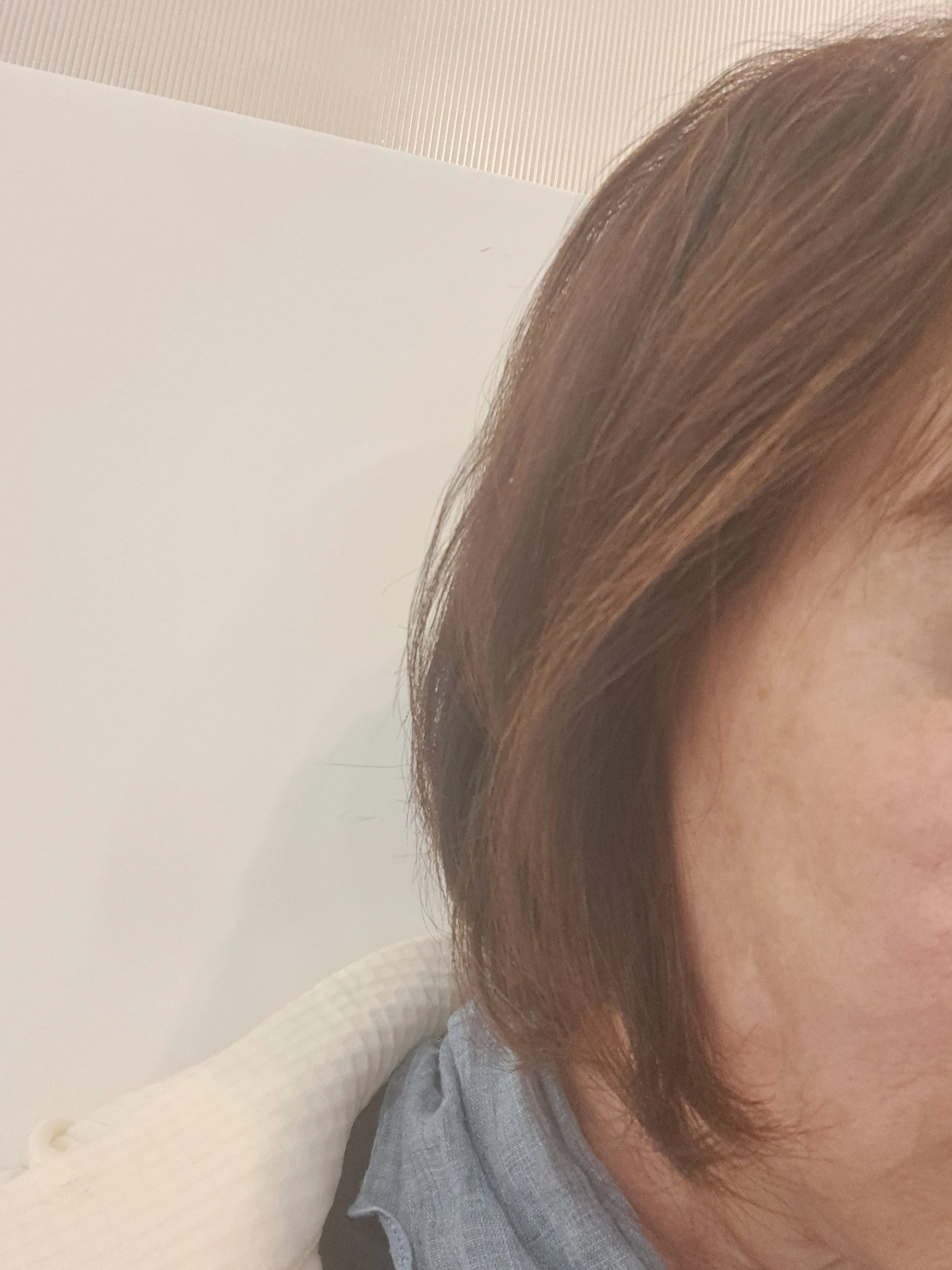 Before treatment — Skin Regeneration #Skin Elasticity #For Fine Lines: Rejuran Healer