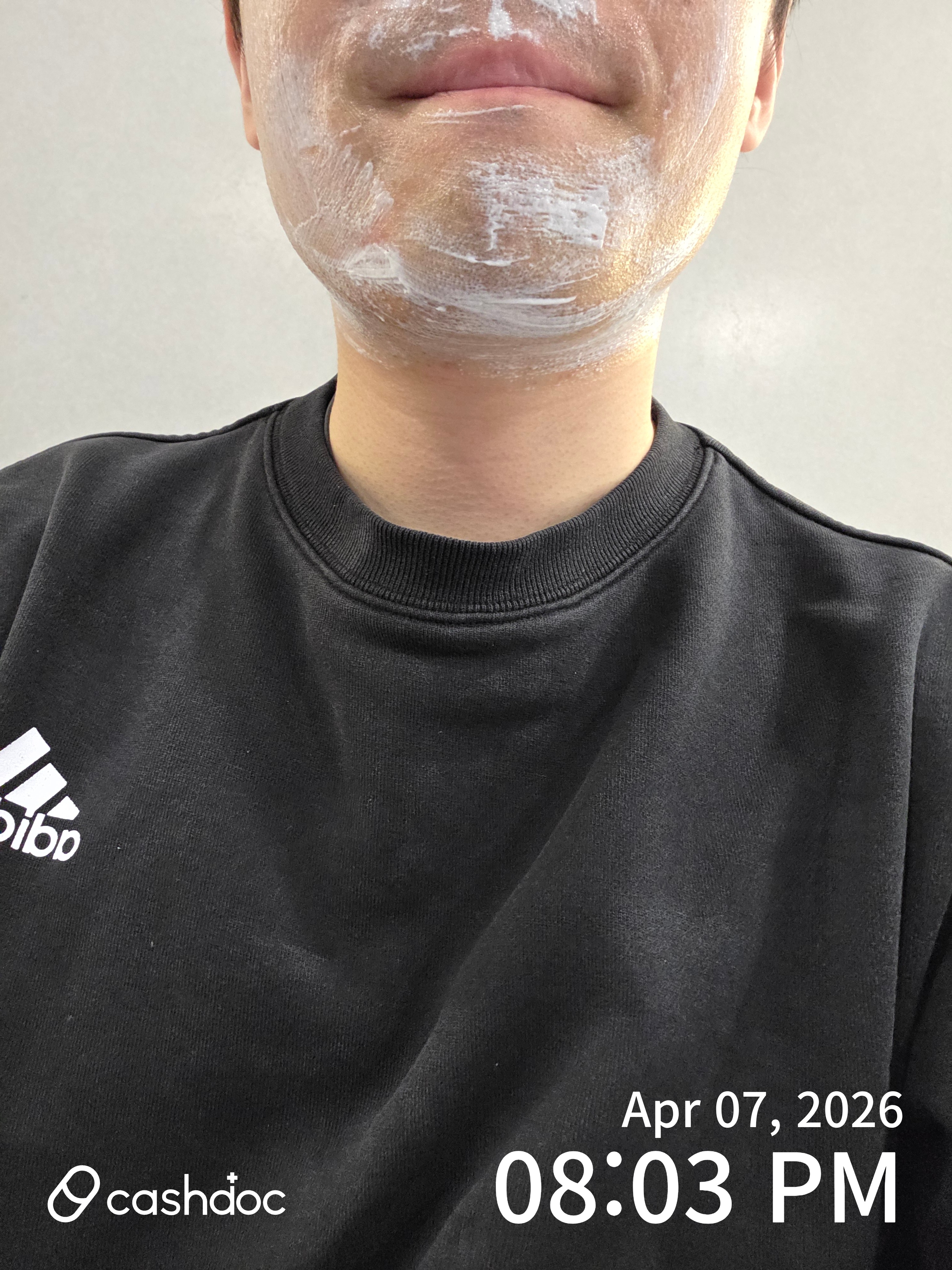 서초구 메티의원, 수염 제모 만족스러워요