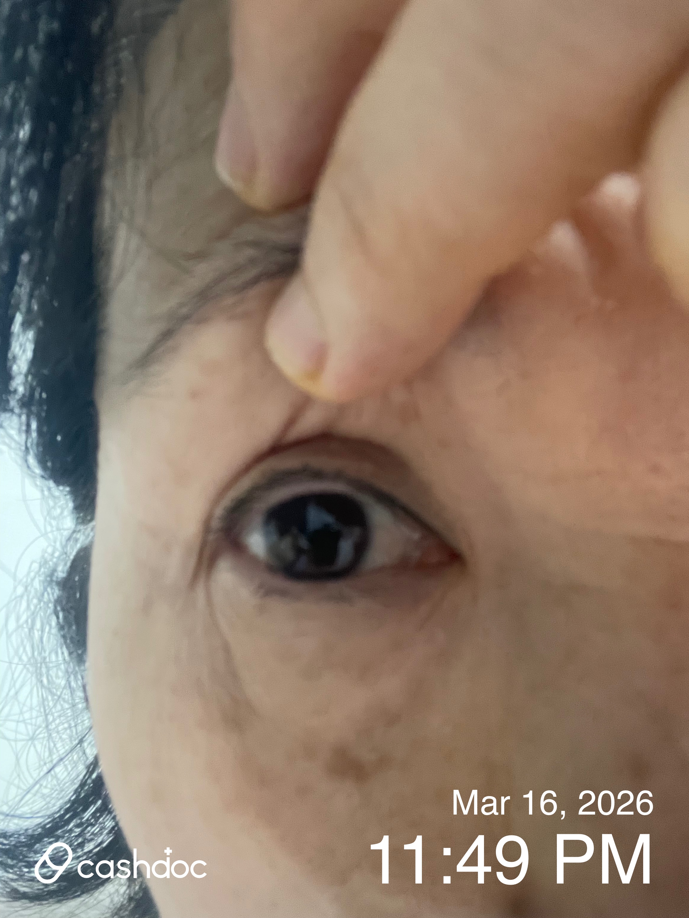 강북구 서울신세계안과, 비문증 레이저 치료 후기