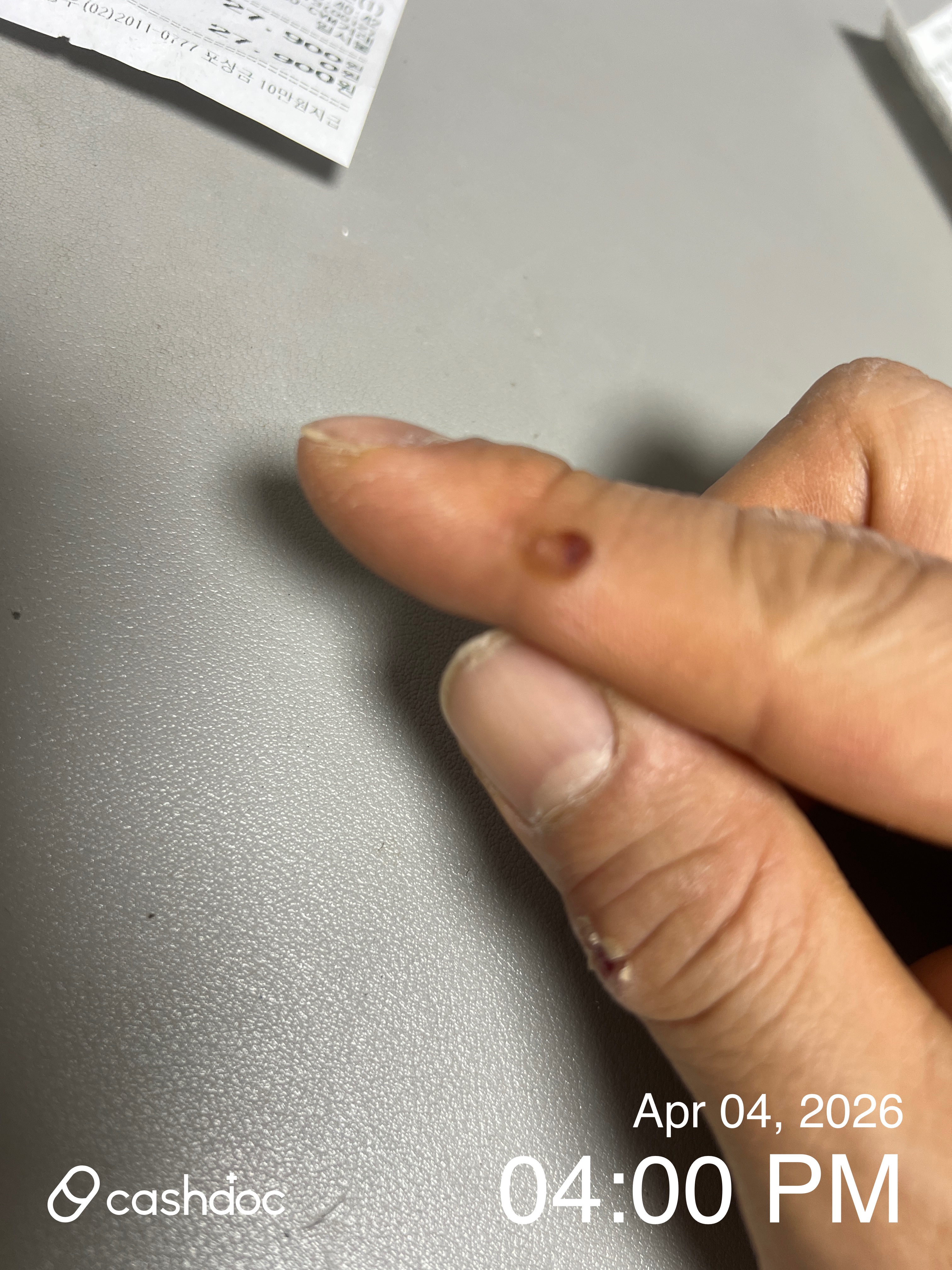 성남시 신영피부과의원에서 사마귀 냉동 치료 경험 공유합니다