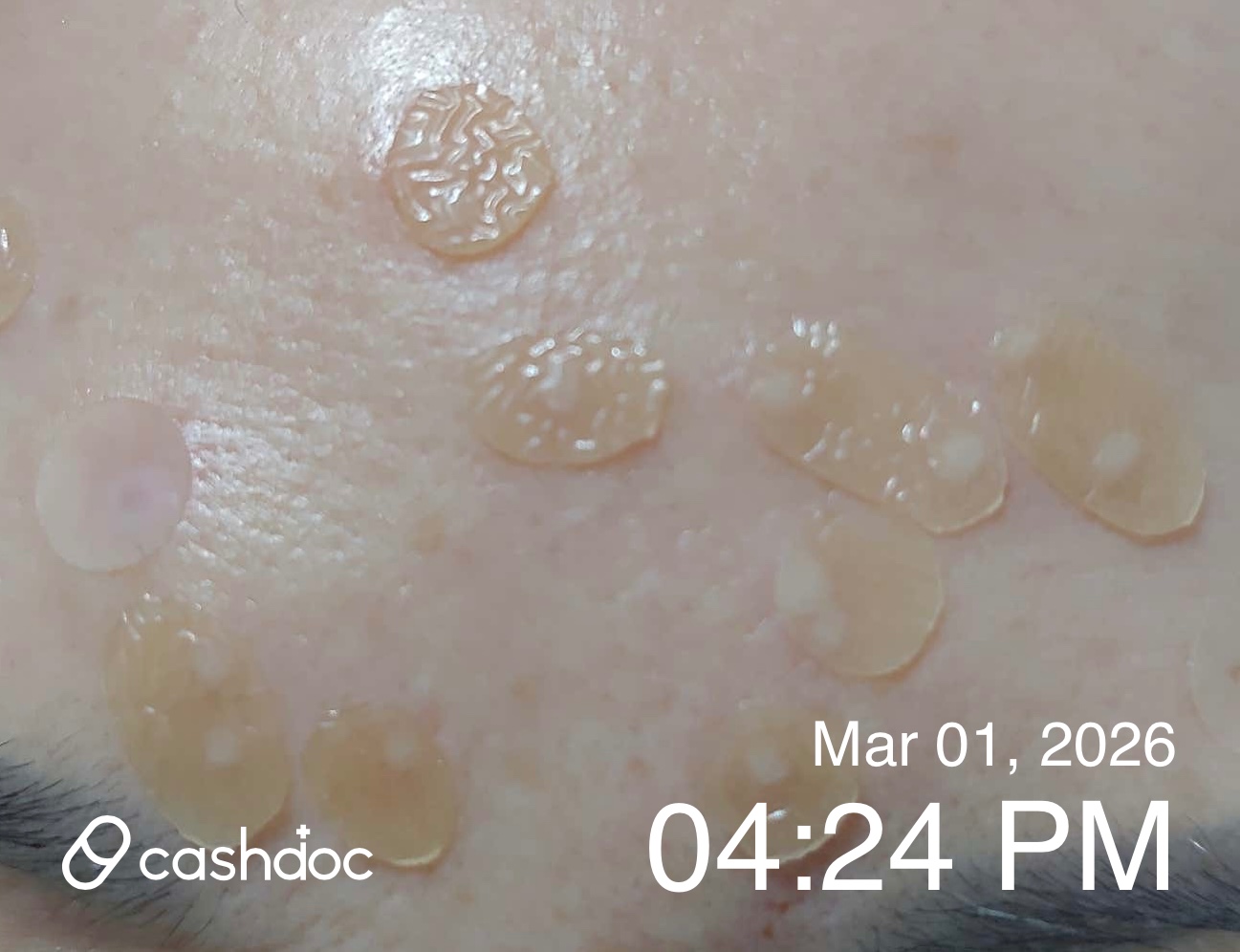 수원시 오라클성형외과의원에서 비립종 제거 후기