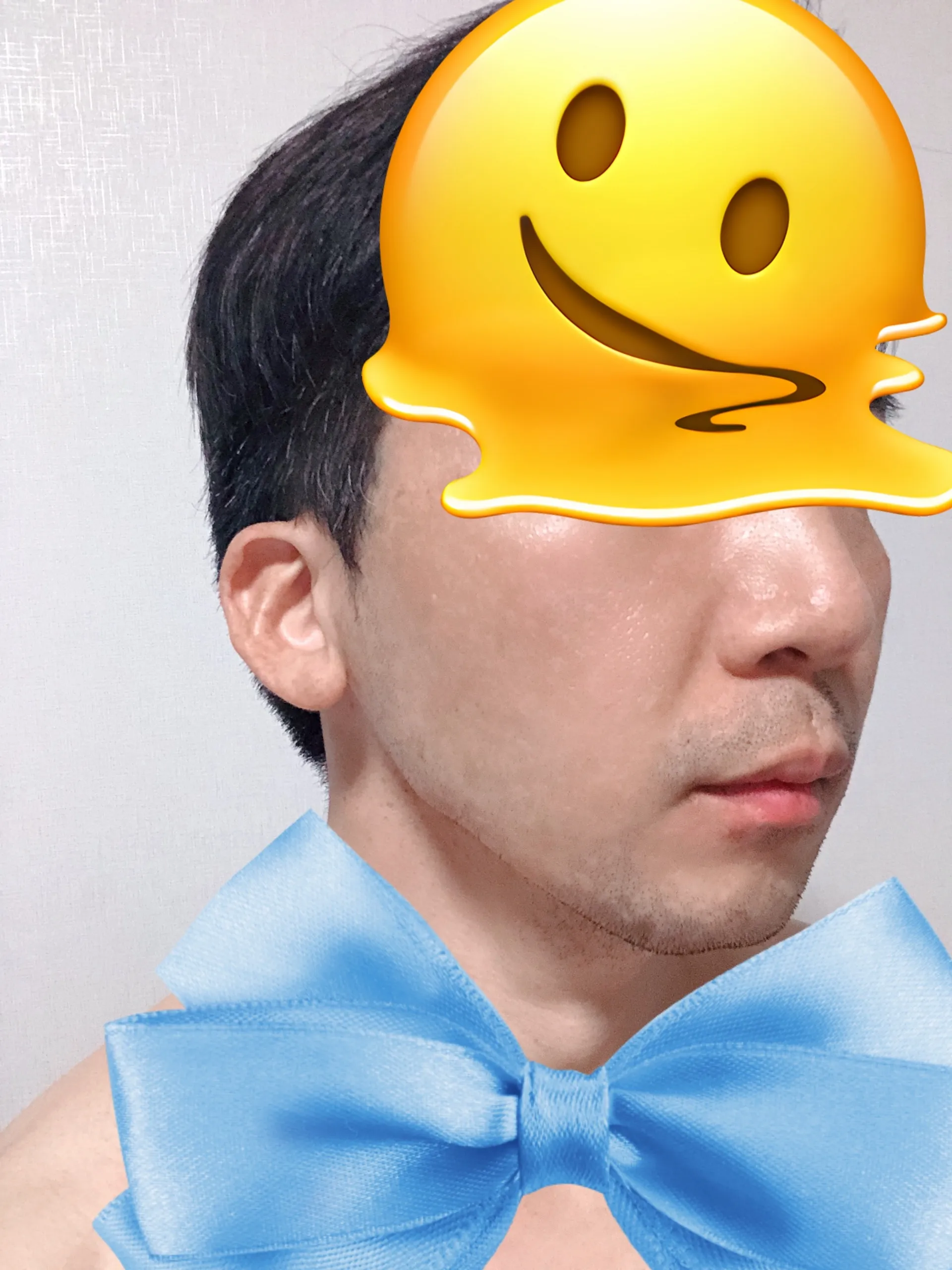 시술 후 — 미케이 피부 탄력개선_슈링크 300샷