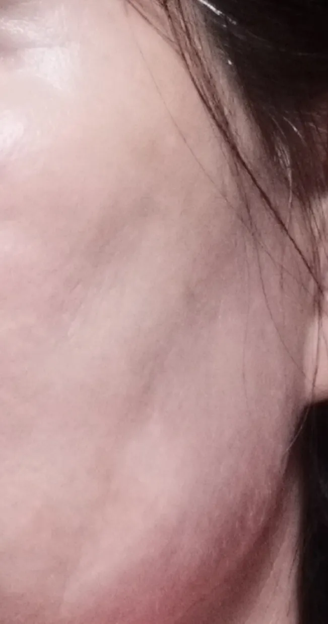 Before treatment — Awesome Rejuran Authentic