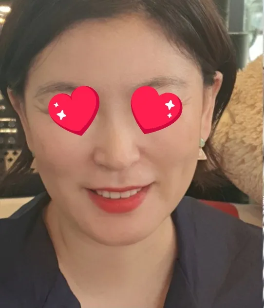 시술 전 — 실리프팅+필러 💙꿈프팅💙 29만원
