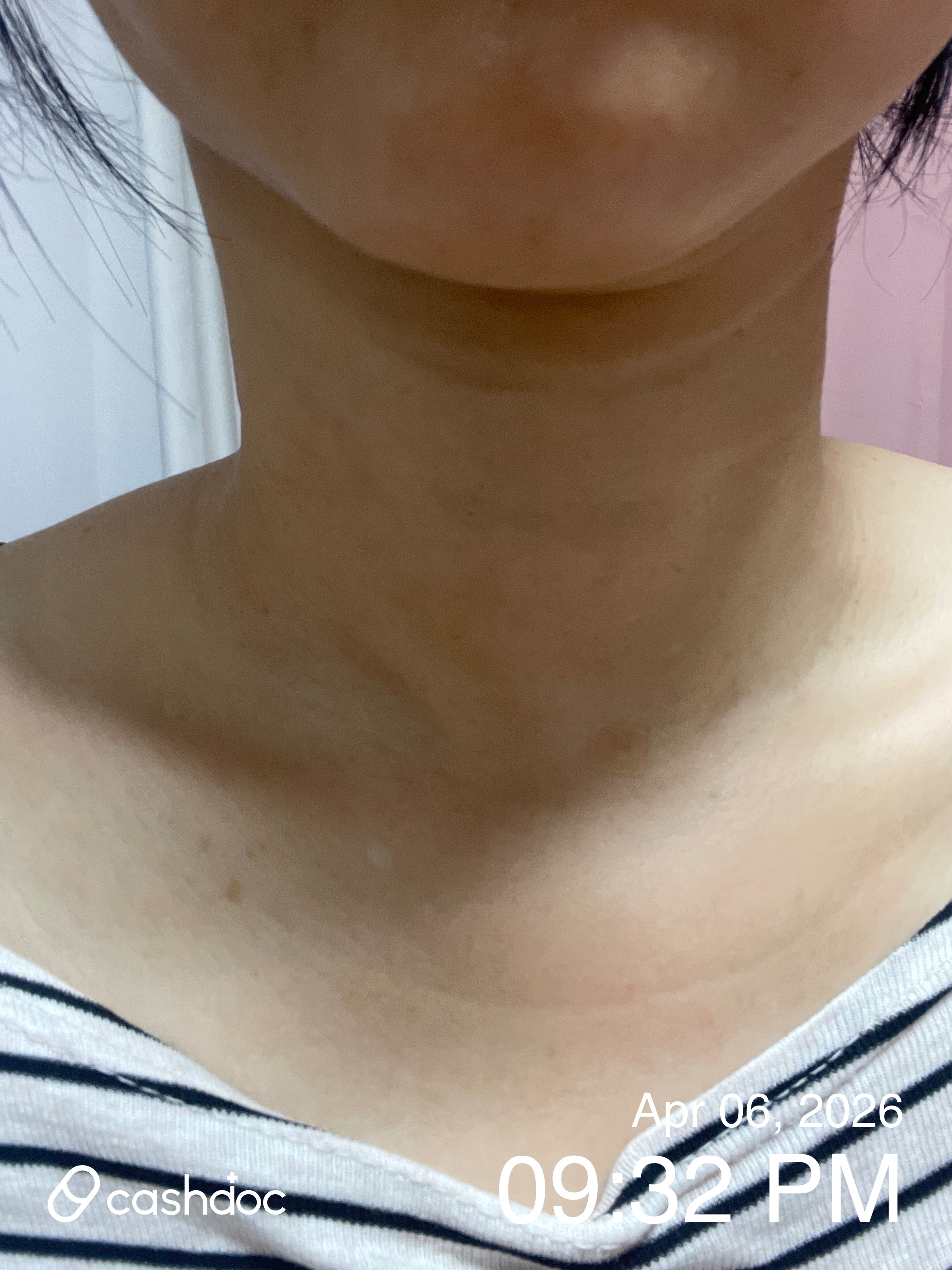 전주시 수경피부과에서 점 제거 경험 좋았어요