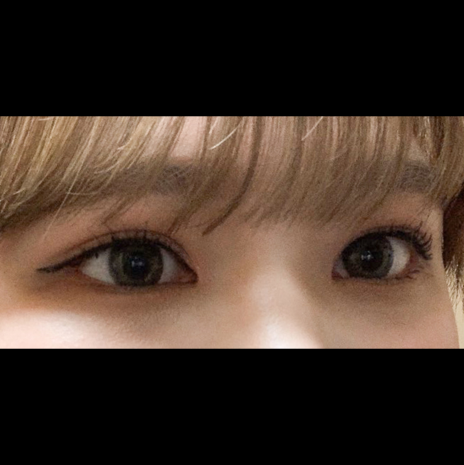 시술 후 — 1mm 숨은 공간까지! 오픈아이 트임