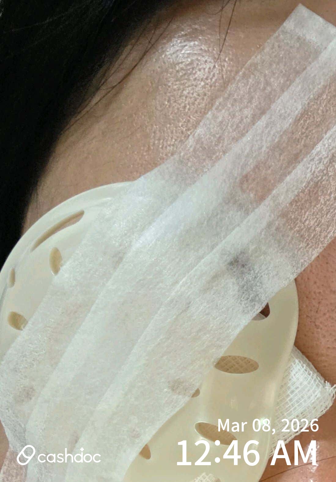 용산구 센트럴서울안과의원에서 난시 수술 후 새 삶을 시작해요