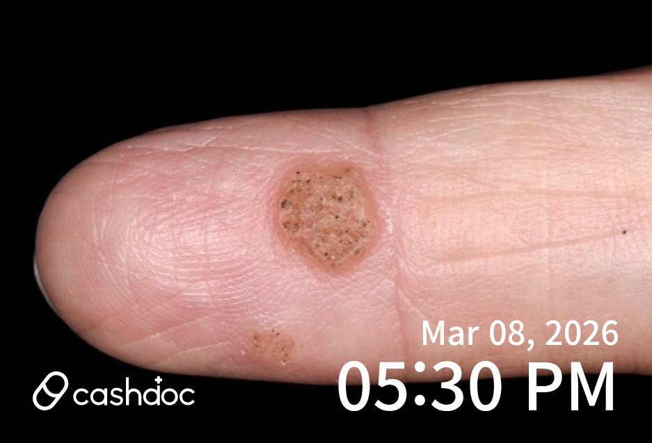 북구 리안의원, 아토피·사마귀 완치 후기!