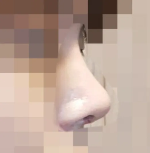 시술 후 — 히든 코성형(비개방 코성형)