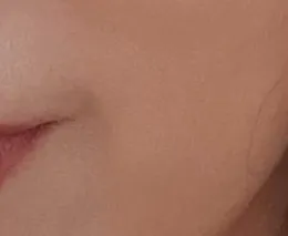 시술 후 — 리본 심술보주사