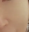 시술 후 — 모공쫀쫀 풀페이스 스킨보톡스