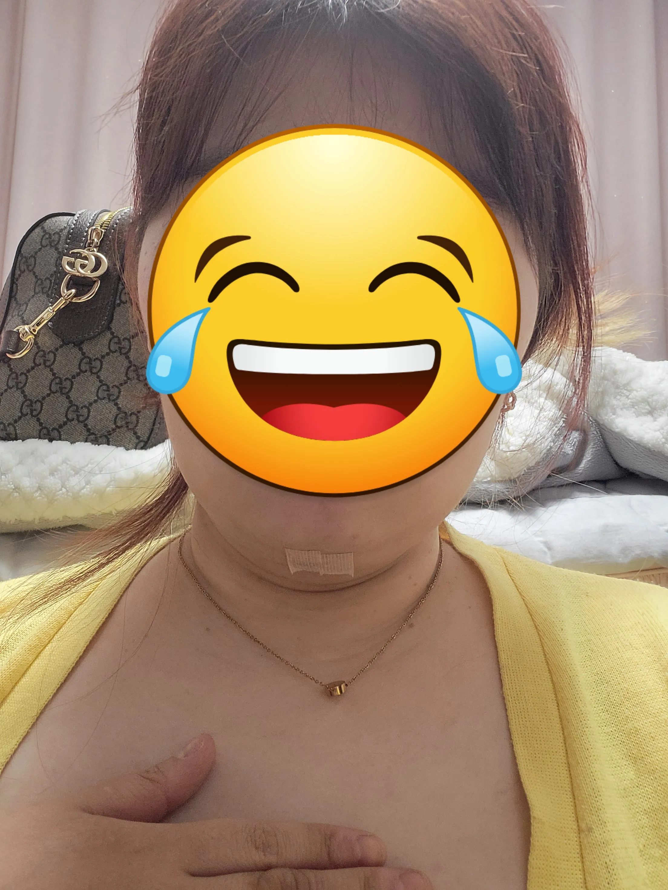 施術後 — プライド二重あご脂肪吸引＆筋束縛