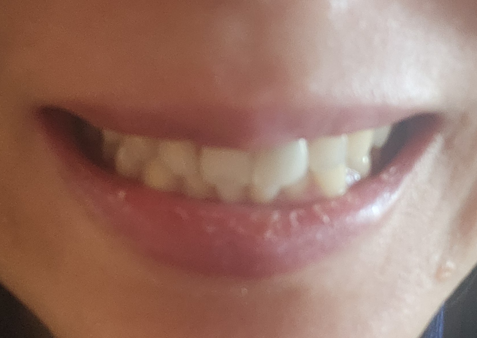 하이파크3로 열린마음치과의원에서 꼼꼼한 스케일링 경험