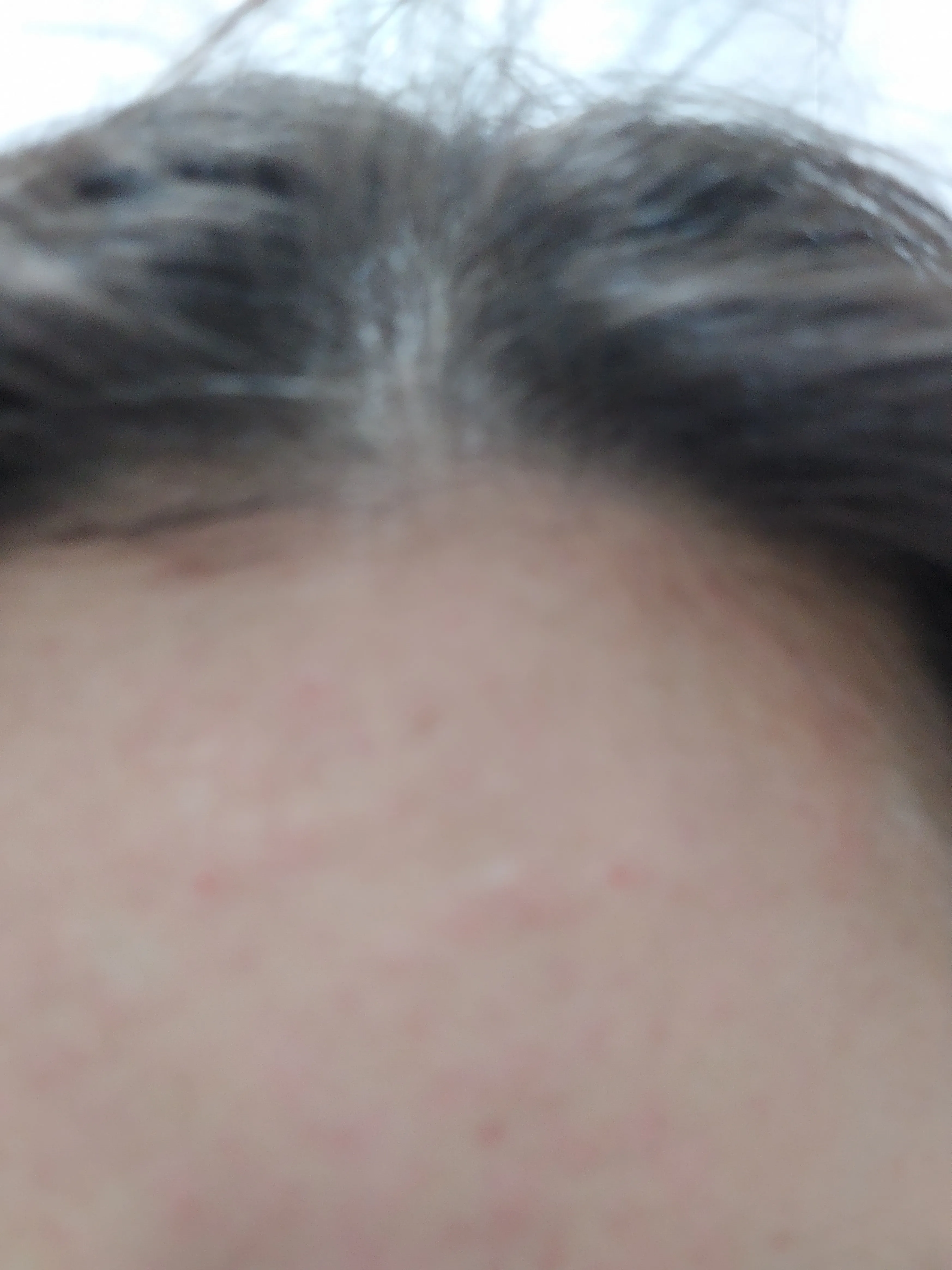 After treatment — Pain reduction special #Rejuran Healer