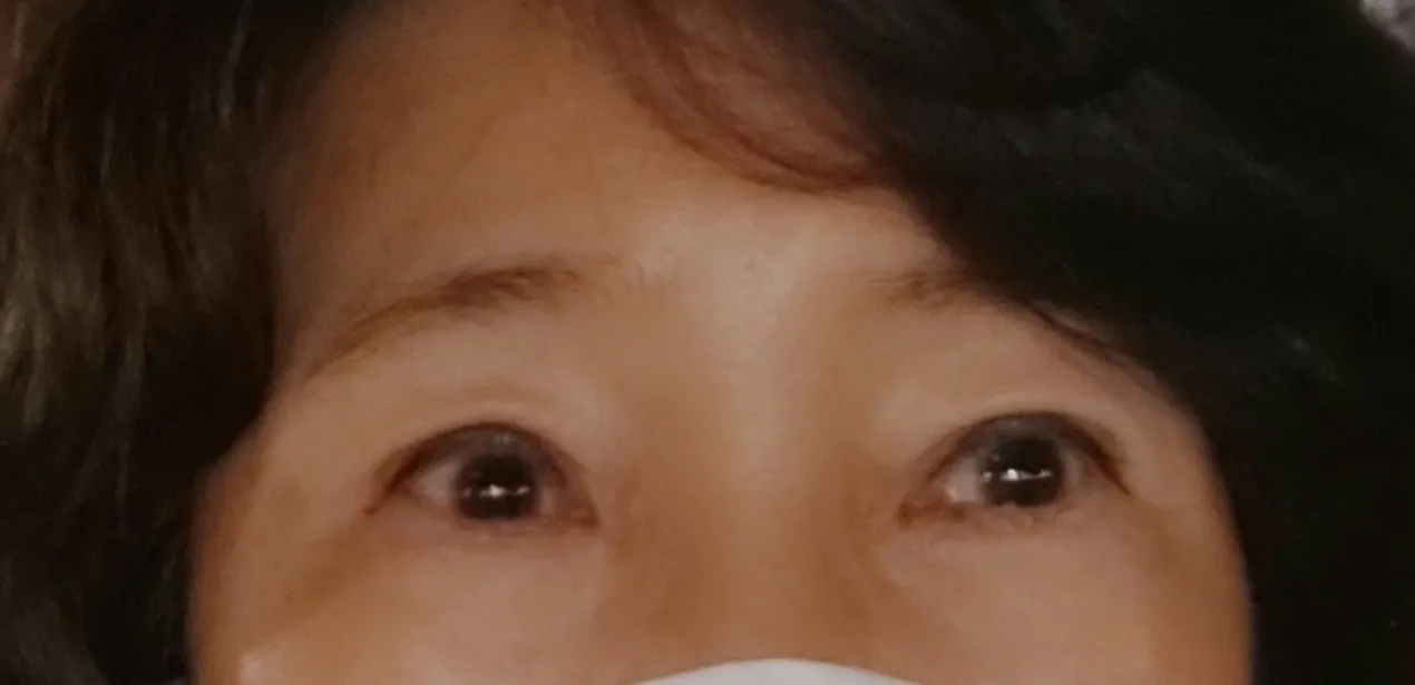 시술 전 — 초간편 반영구 패키지