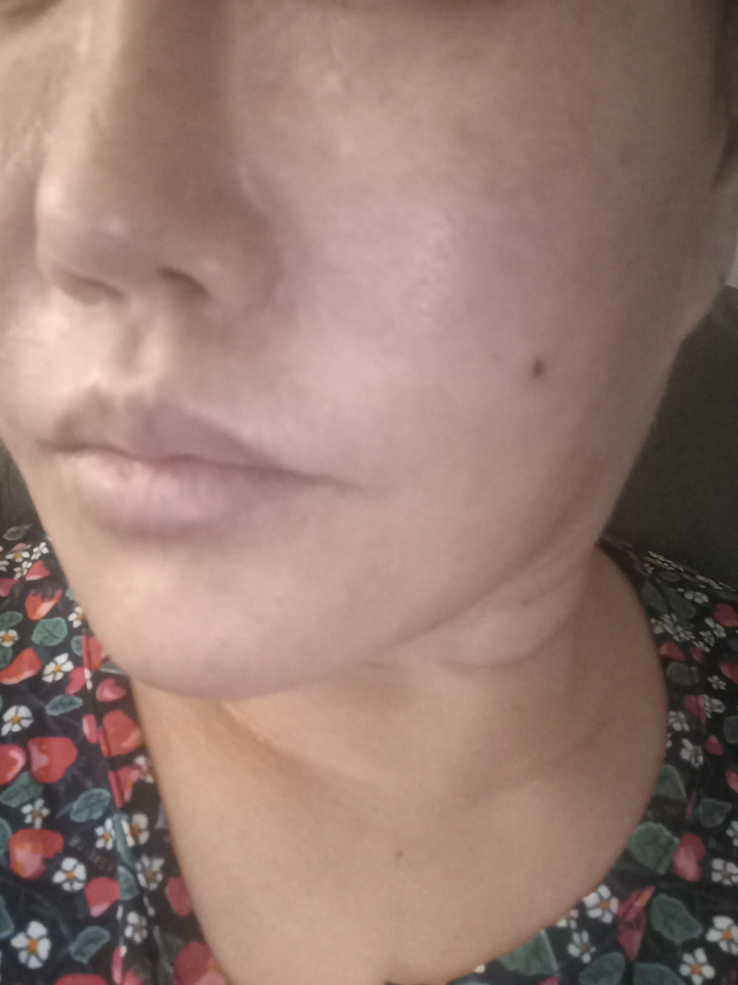 After treatment — [First Visit Event] Contour Botox