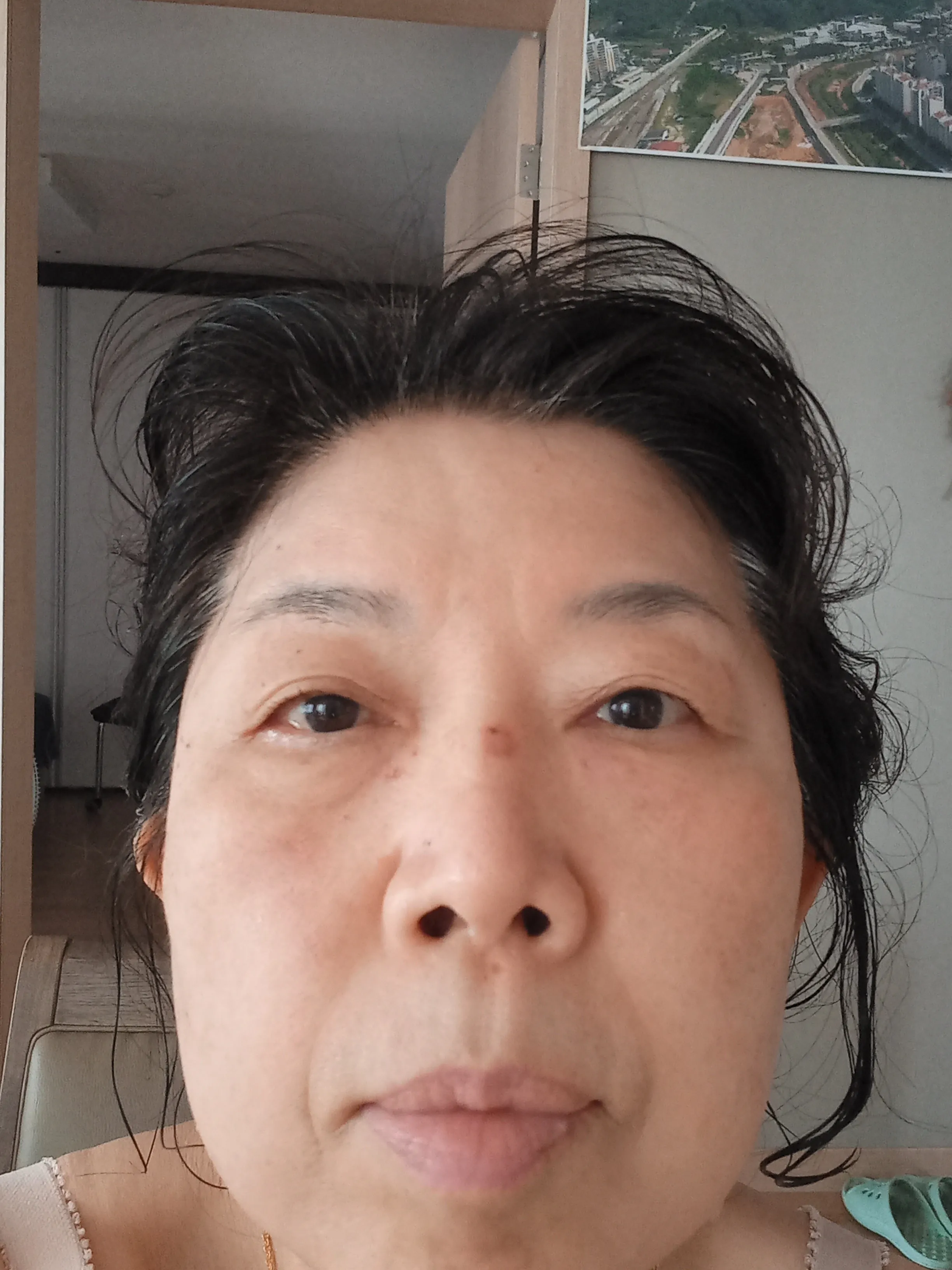 시술 후 — 디오레 아기레이저