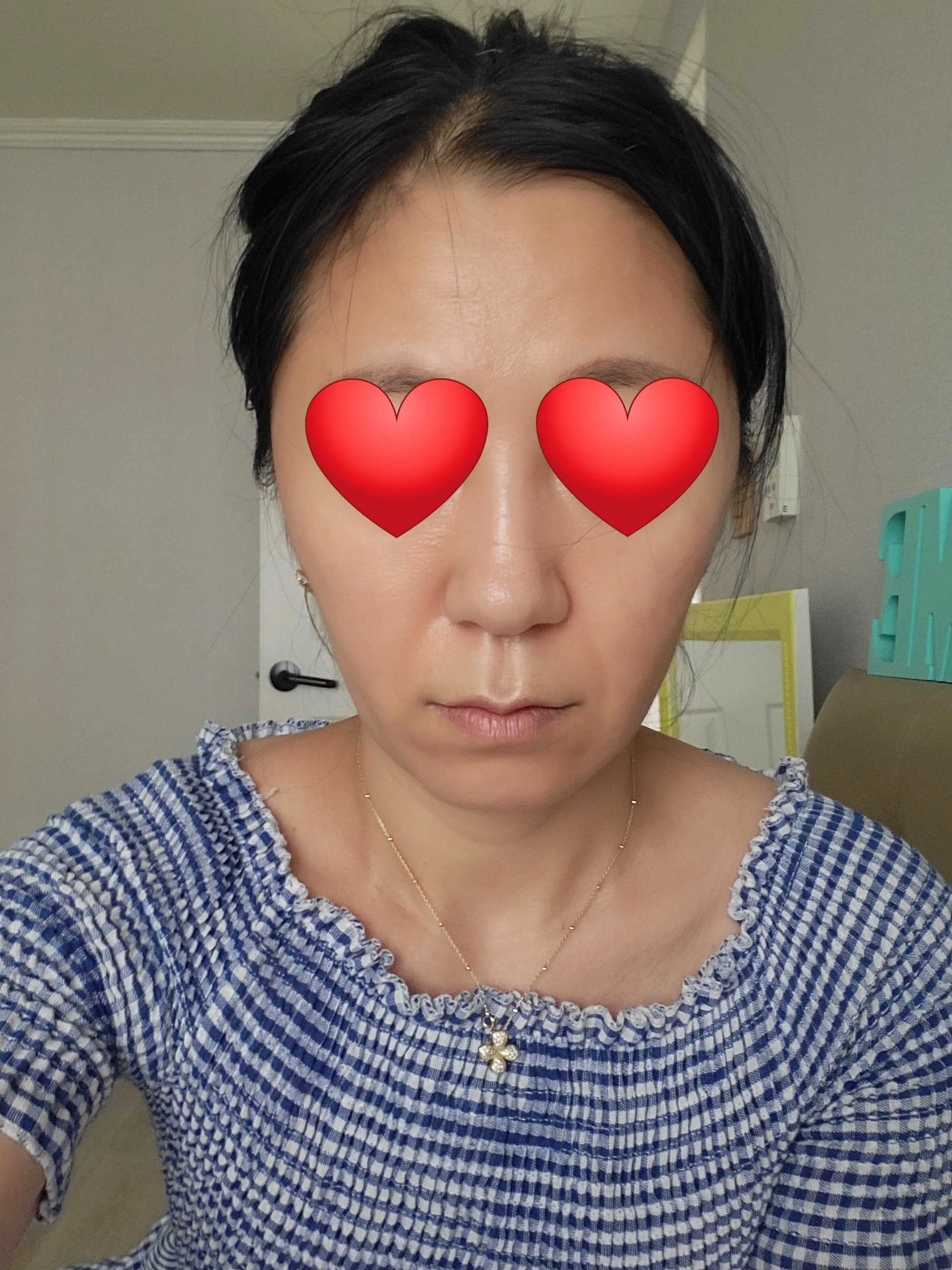 시술 전 — 미케이 인모드 포마_얼굴탄력,브이라인