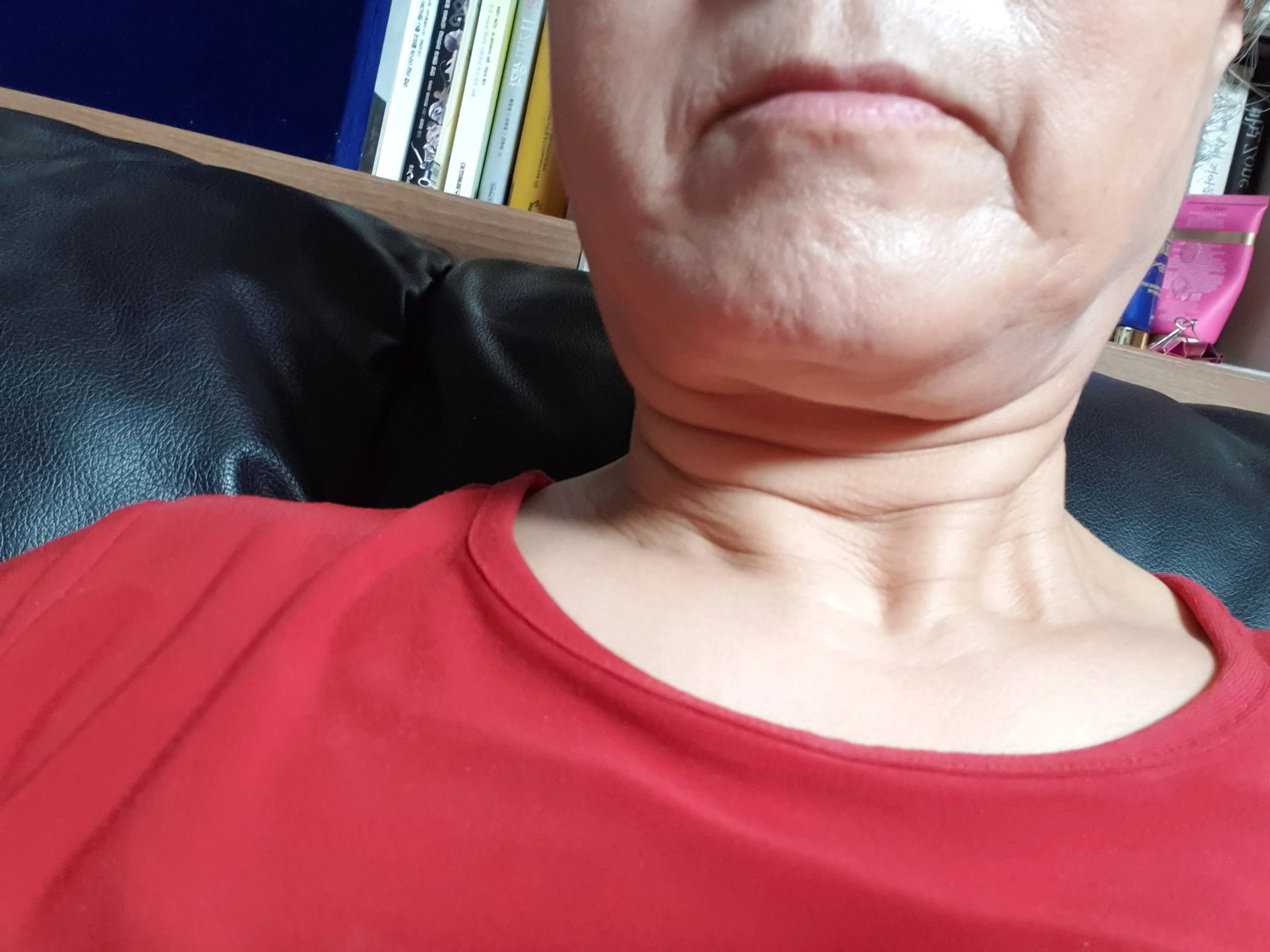 시술 전 — 1회시술 3년유지💜콜라겐 실리프팅