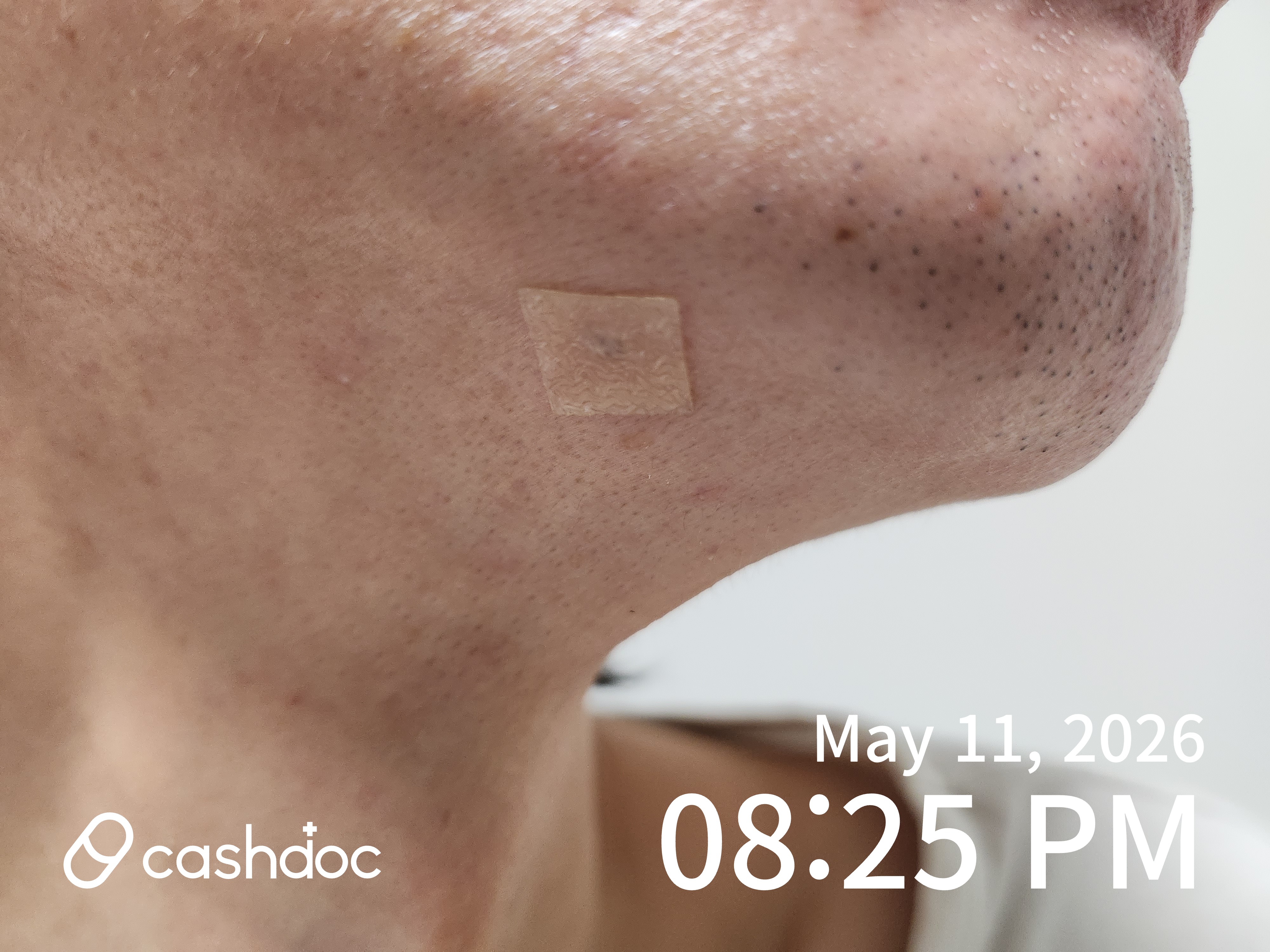 Maypure Clinic in Namyangju, Mole Removal Procedure Review