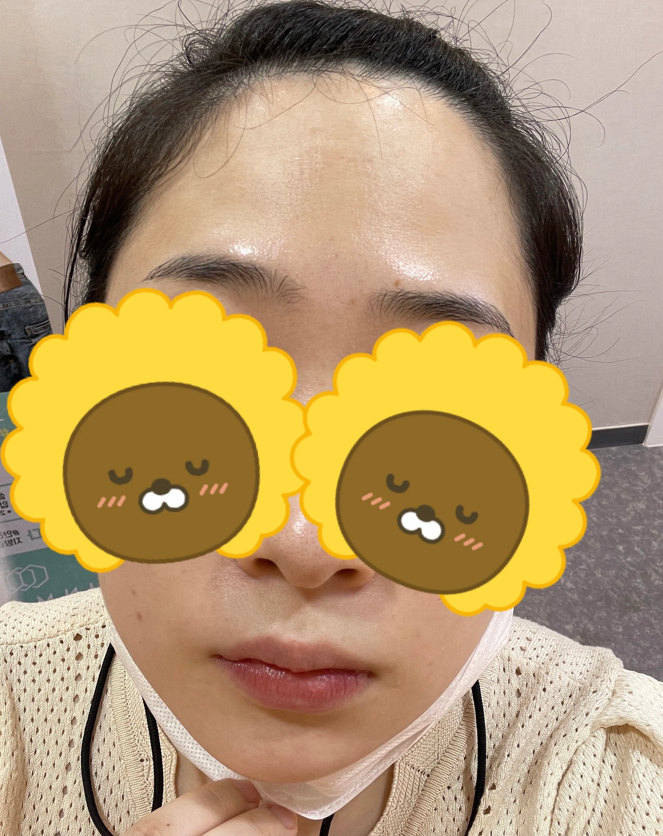시술 전 — 기미/색소 완벽파괴! #대세 피코토닝