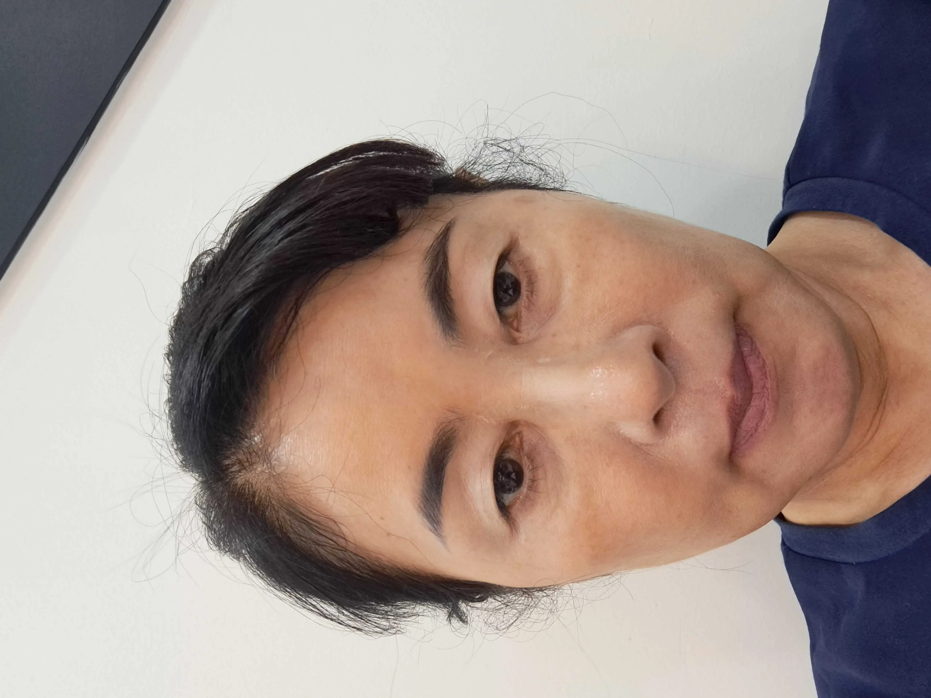 시술 전 — 미케이 피부색소 지우개