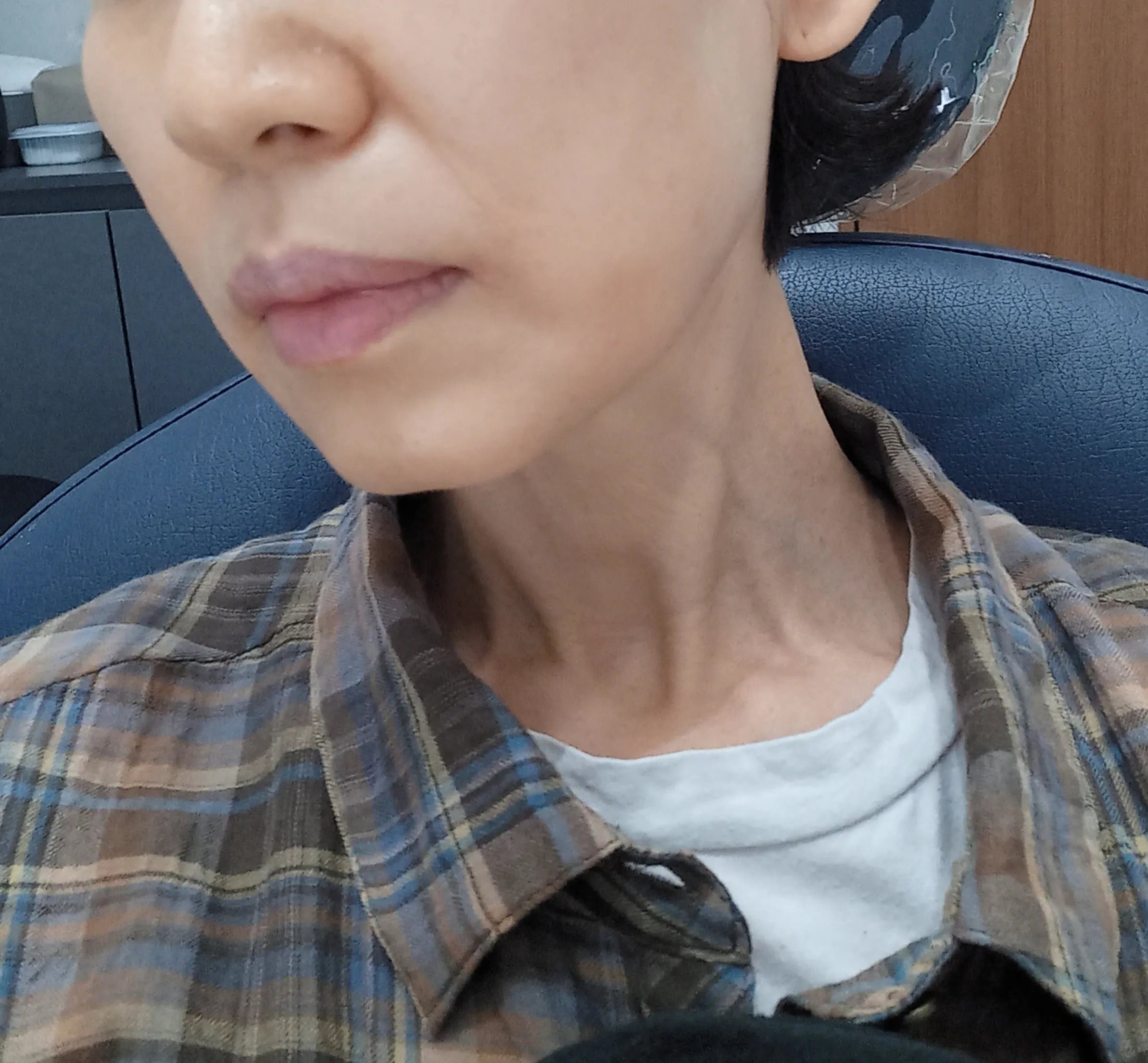 시술 후 사진