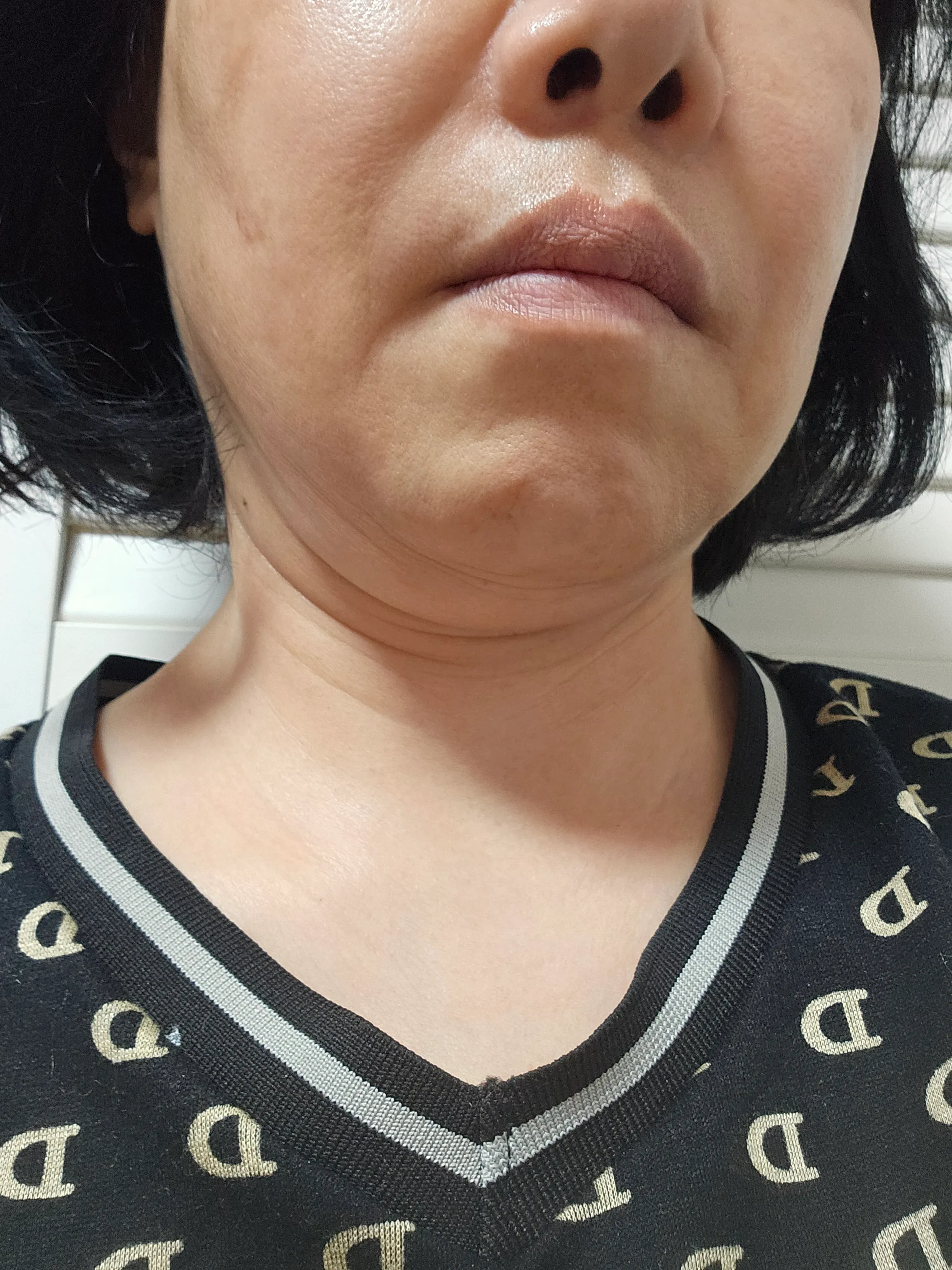 시술 전 — 미케이 기미&주근깨 개선_레이저토닝