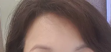 项目后 — 计划者♥内窥镜额头提升