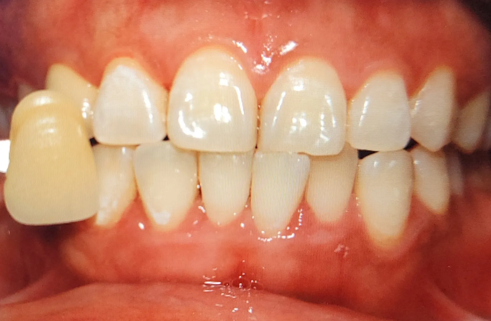 After treatment — 30-Minute Complete Teeth Whitening Program
