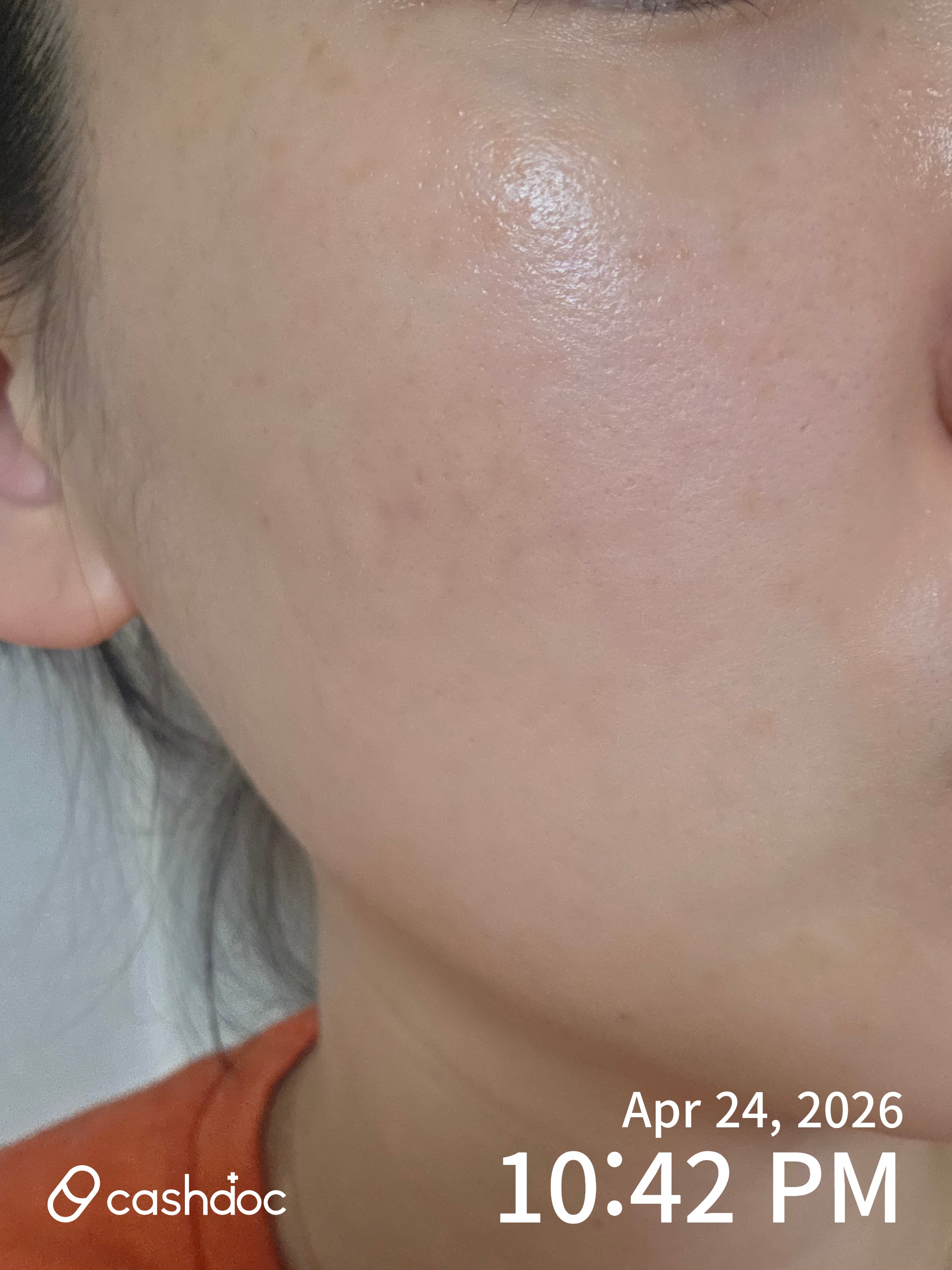 용인시 메이퓨어의원 수지점에서 기미 치료 후기!