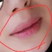 시술 전 — 입술필러&입꼬리 보톡스