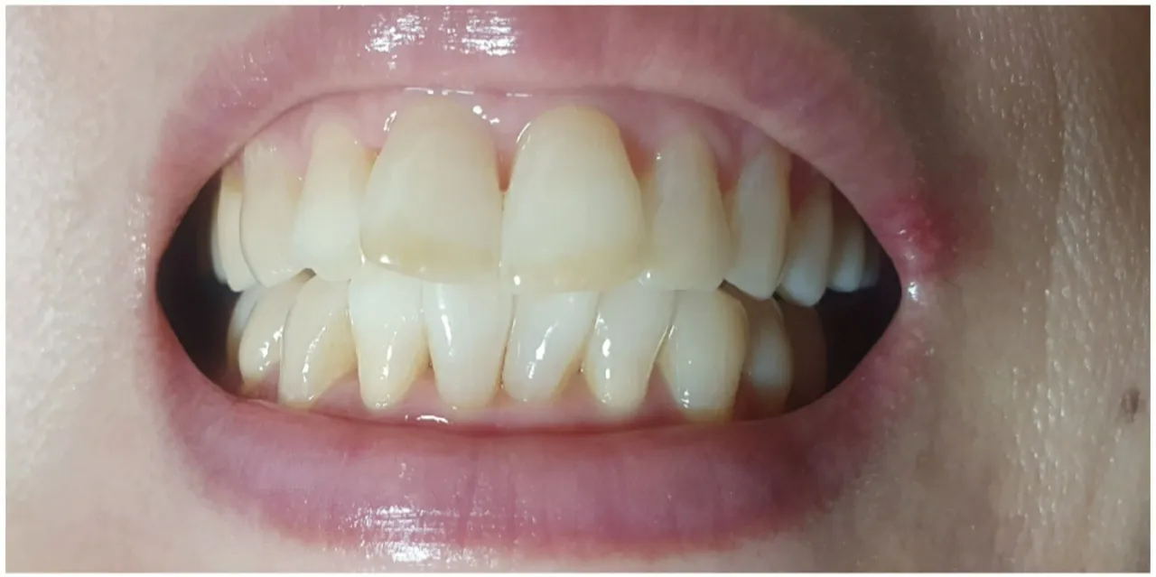 Before treatment — Teeth whitening, really! ♥ 39,000 won ♥