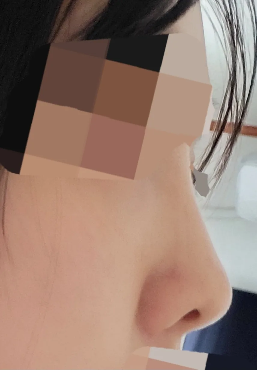 시술 전 — 코필러 하이코 대신  레이디코