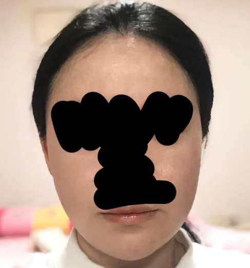 After treatment — Wonjin_Facial Contouring