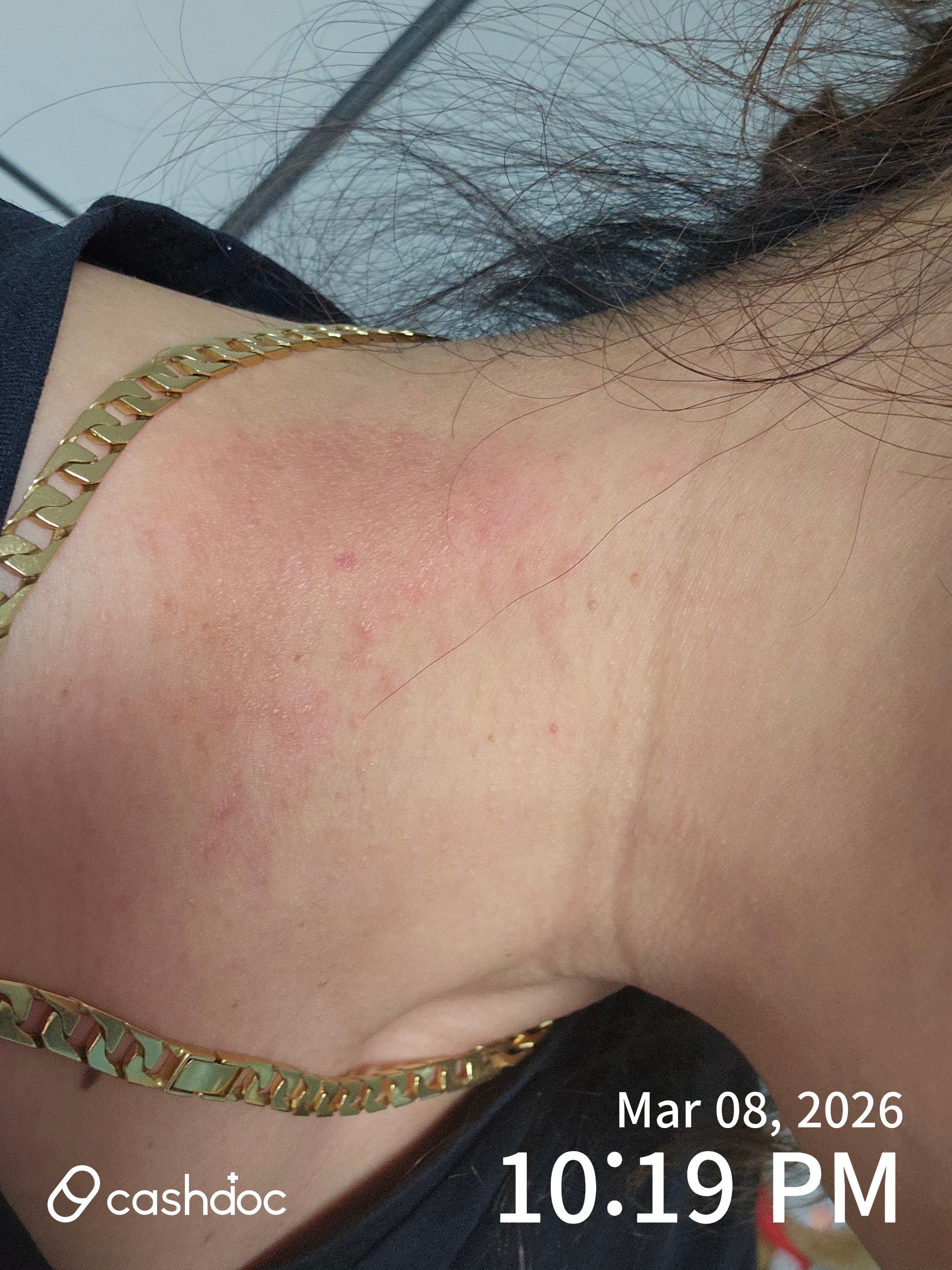 북구 공피부과의원에서 알러지 증상 완화 경험