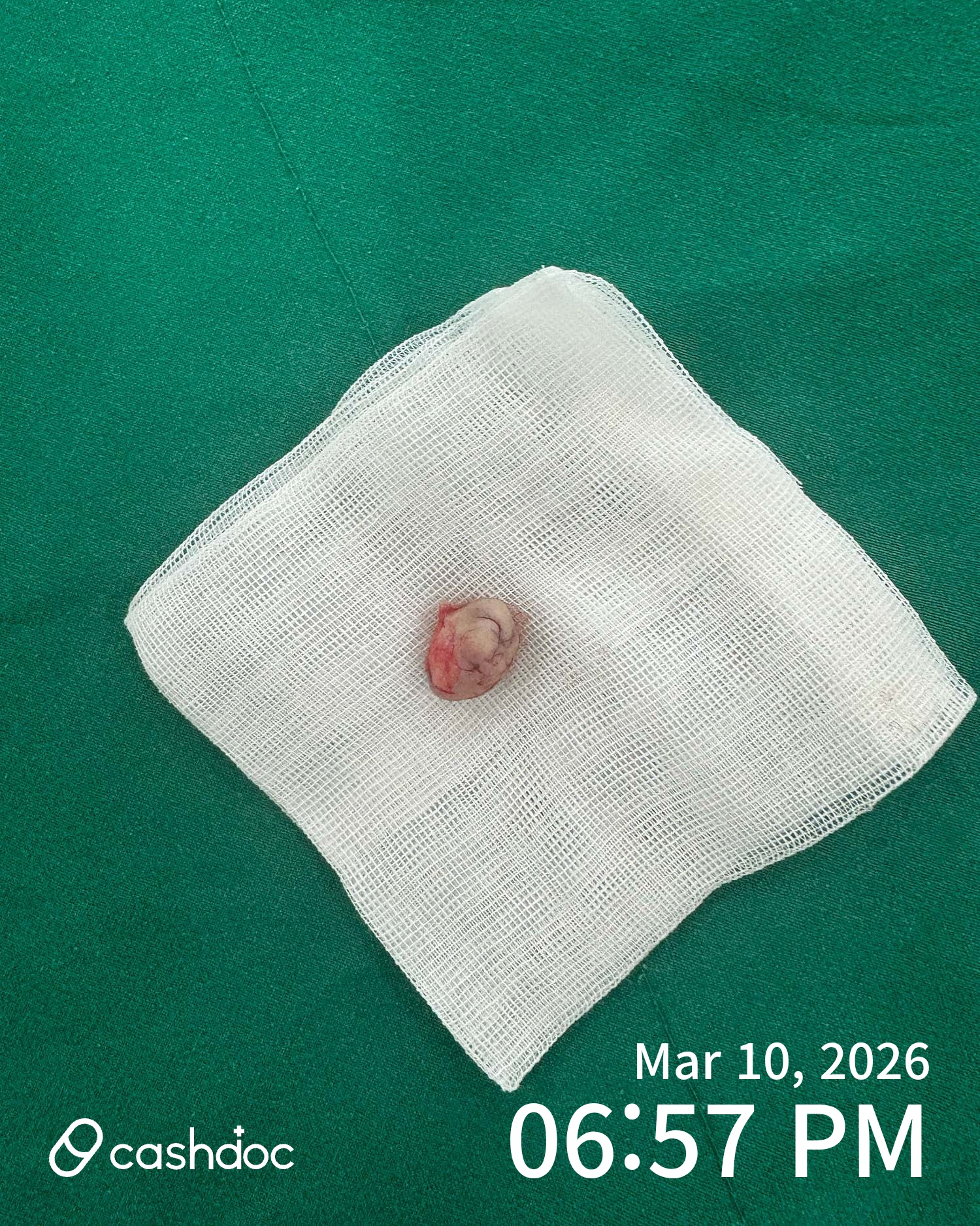 강동중앙내과외과의원에서 켈로이드 수술 후 만족스러운 후기