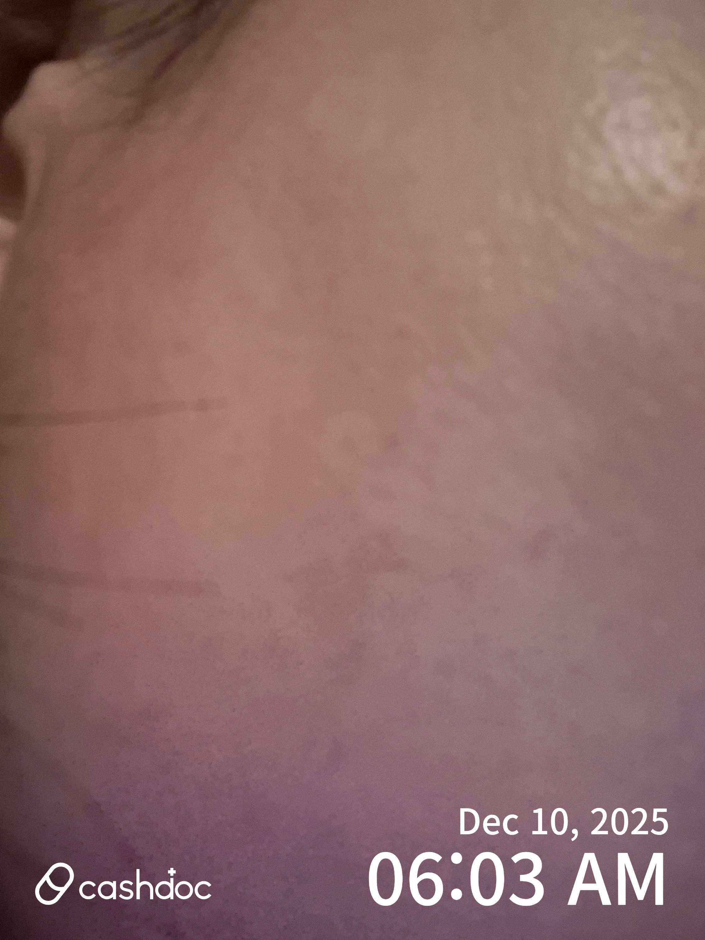 강남구 스테이영피부과의원, 기미 치료 후 만족도 높아요