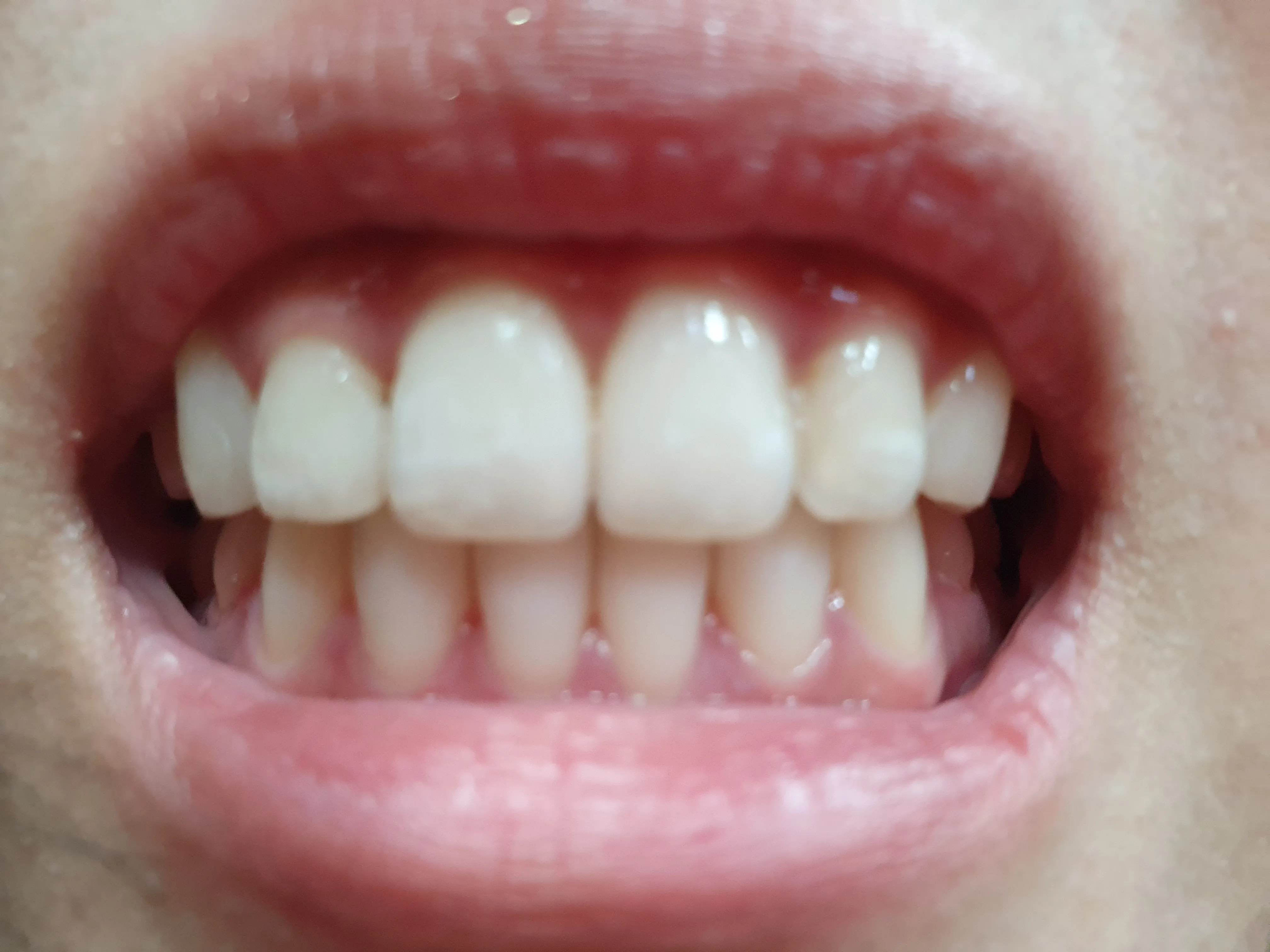 After treatment — 30-Minute Complete Teeth Whitening Program