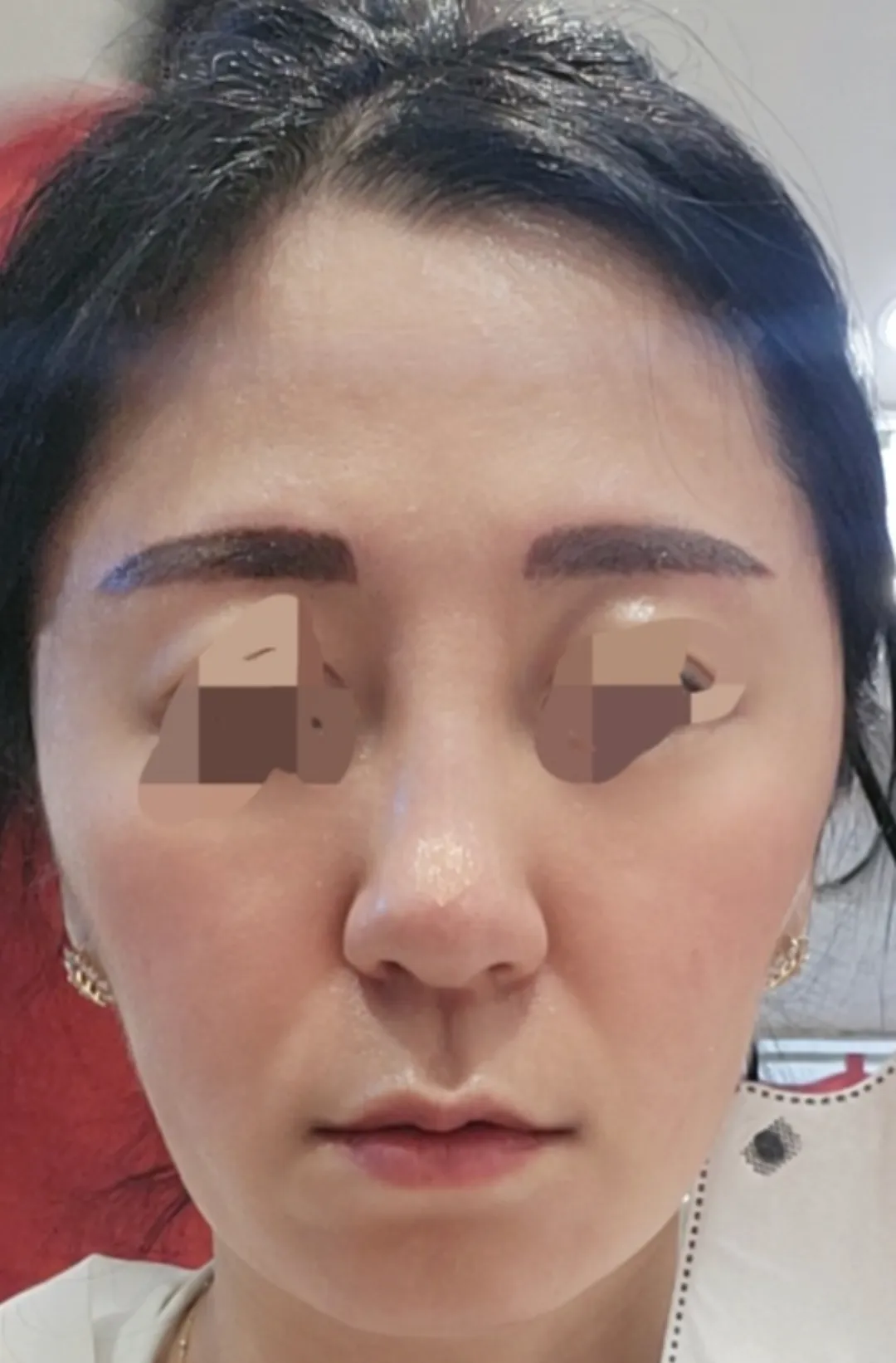 施術後 — ミケイ 自信のある鼻筋 ミント糸_ハイコ